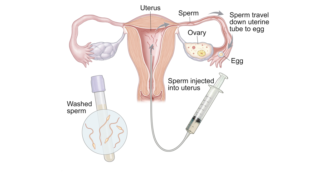 Intrauterine insemination