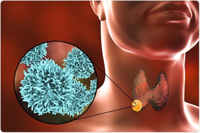 Thyroid Due To Cancer