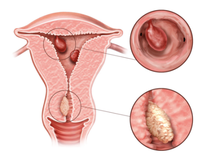 hysteroscopy and polypectomy