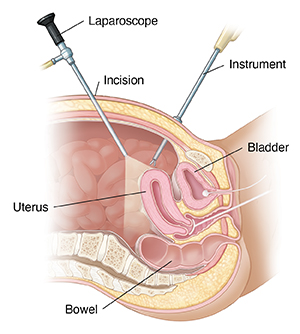 Total Laparoscopic Hysterectomy - TLH